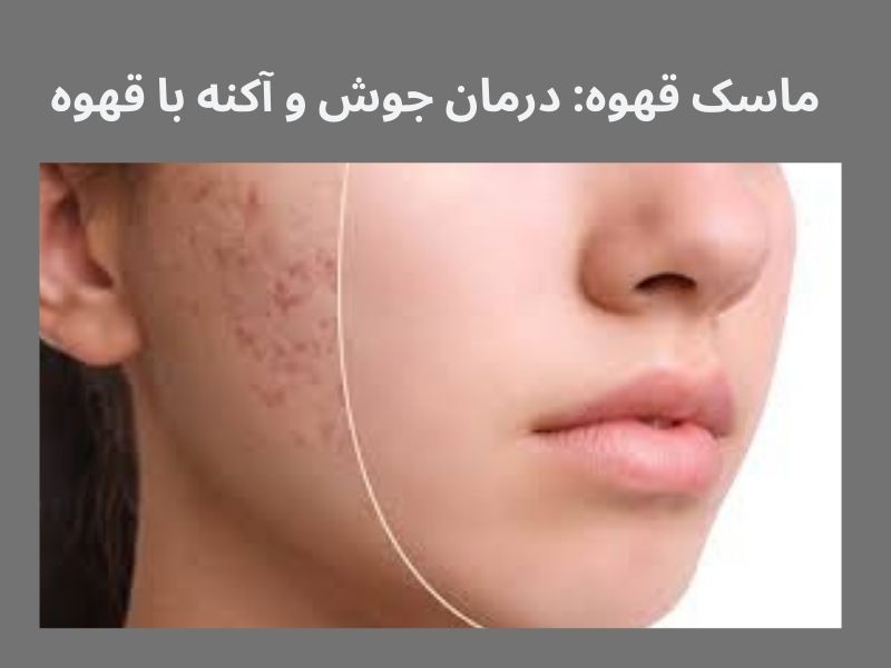 درمان جوش با قهوه